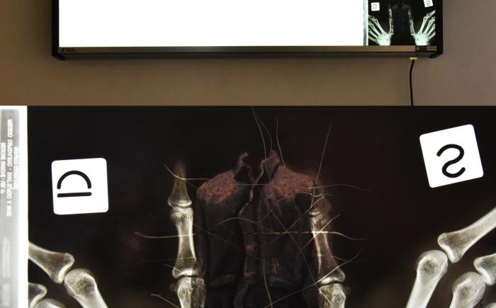 Traces, 2025, installazione, negativoscopio e olio su radiografie